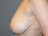 Patient # 87772 Before Photo # 5